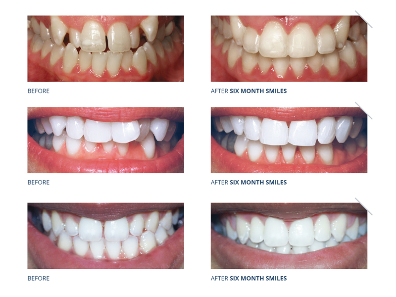 Six Month Smiles results gallery